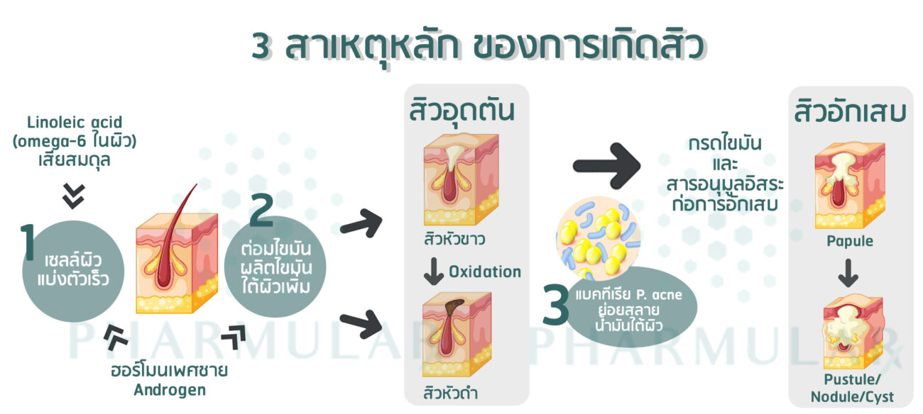 สาเหตุการเกิดสิว 3 ข้อ: เจาะลึกต้นตอปัญหา