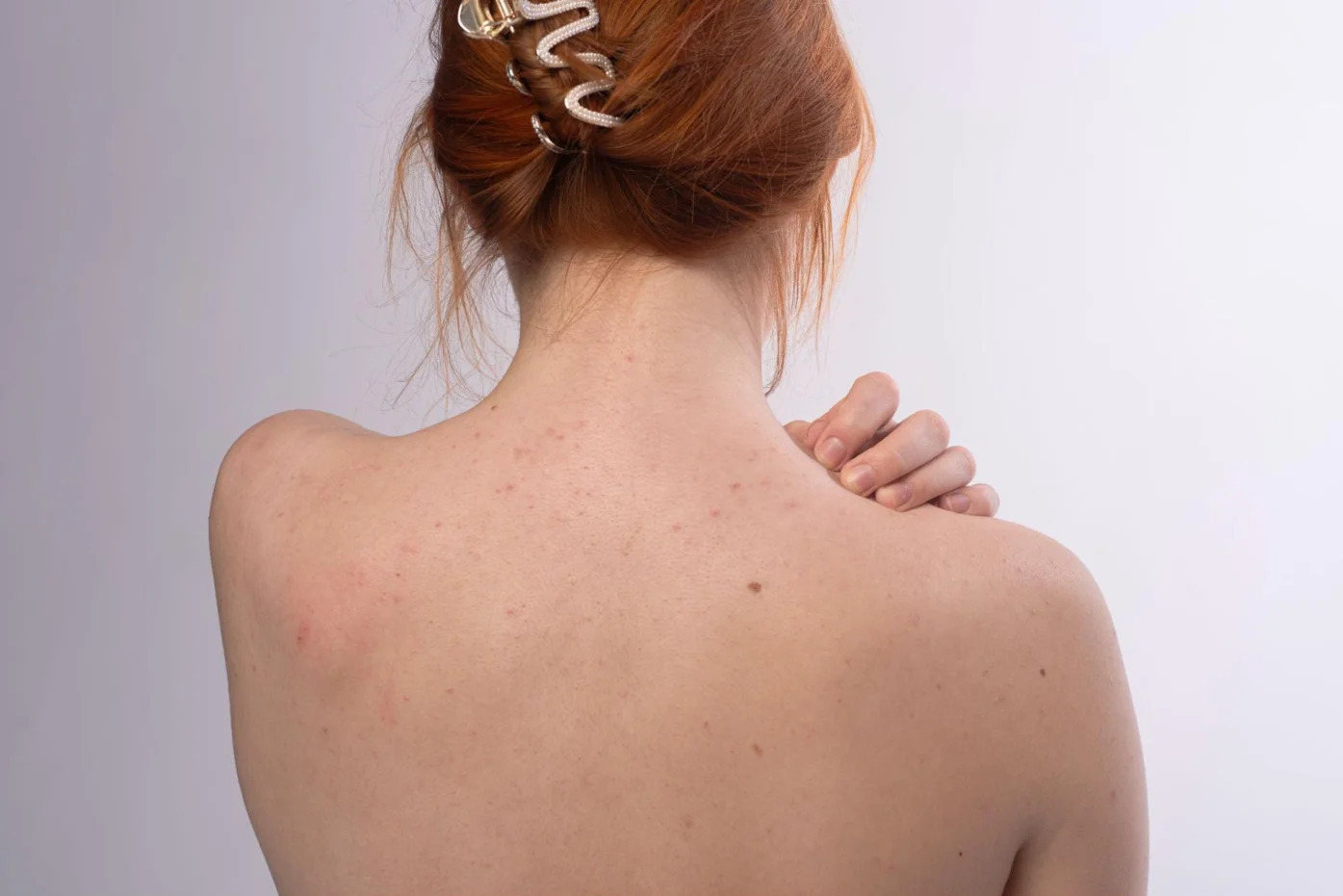 สิวที่หลังเกิดจาก