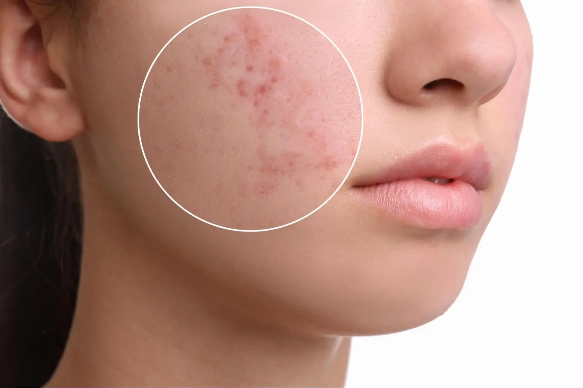 Acne