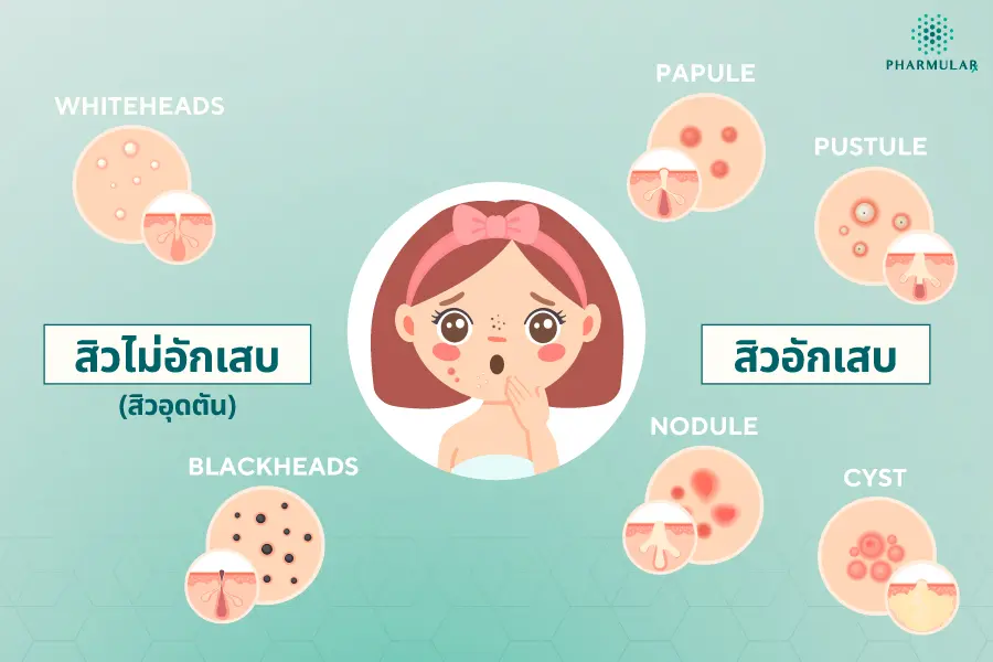 สิวมีกี่ชนิด