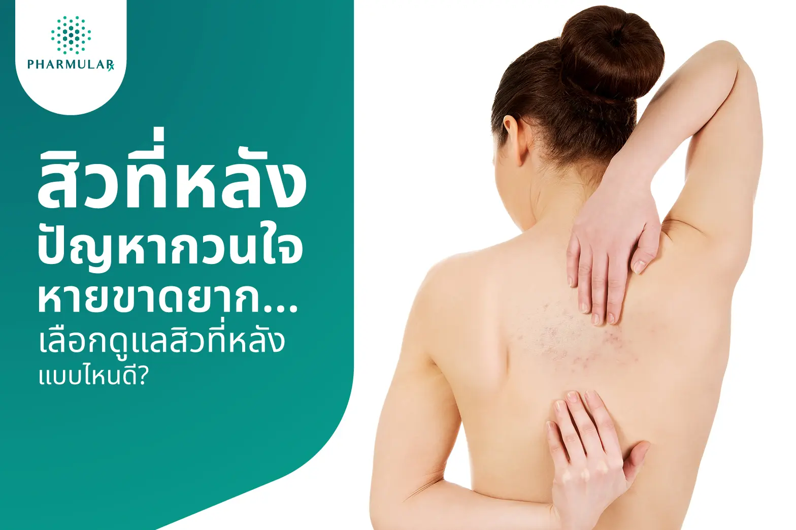 สิวที่หลัง