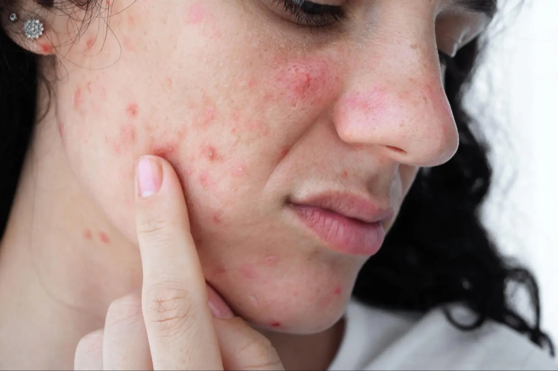 ความรุนแรงของสิว เจลแต้มสิวช่วยได้