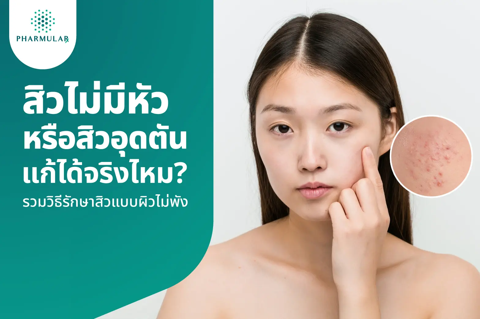 สิวไม่มีหัว นูน ๆ รักษายังไง