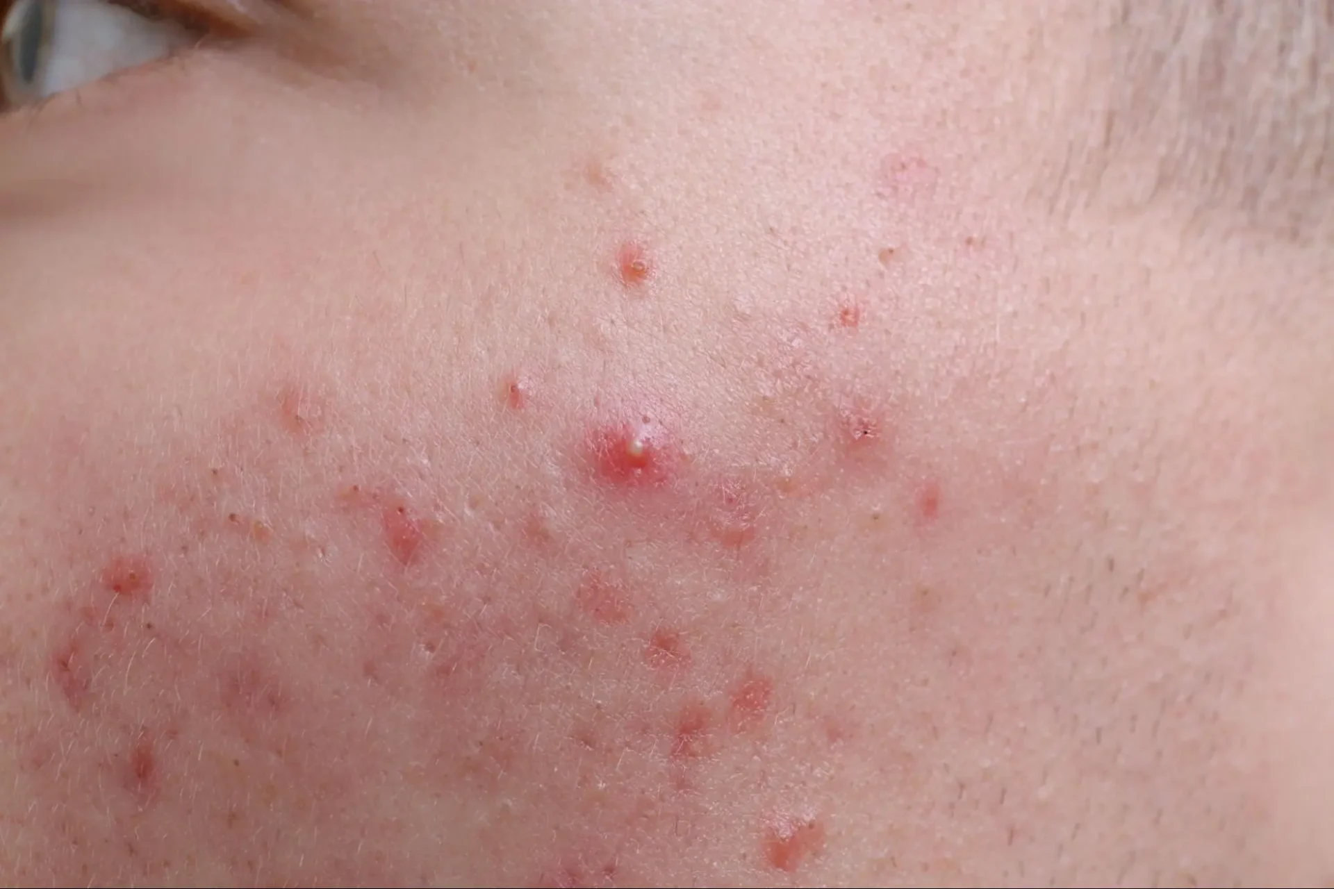 สิวหัวหนองเกิดจาก