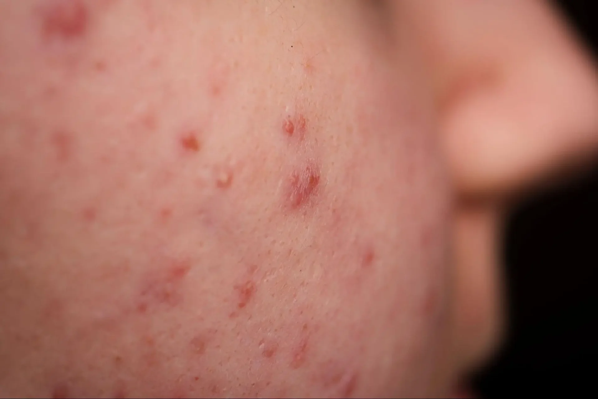 สิวอักเสบ