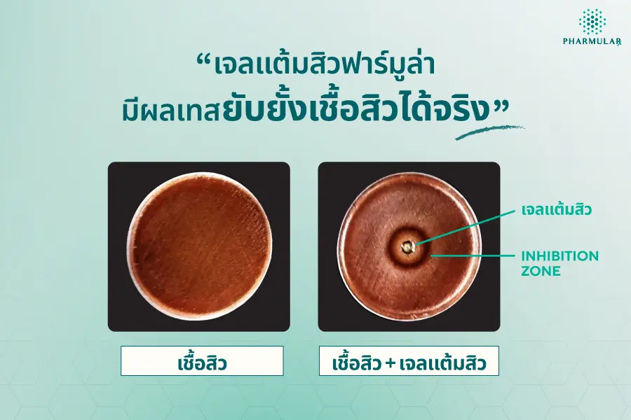 ผลทดสอบเจลแต้มสิวจาก Pharmular