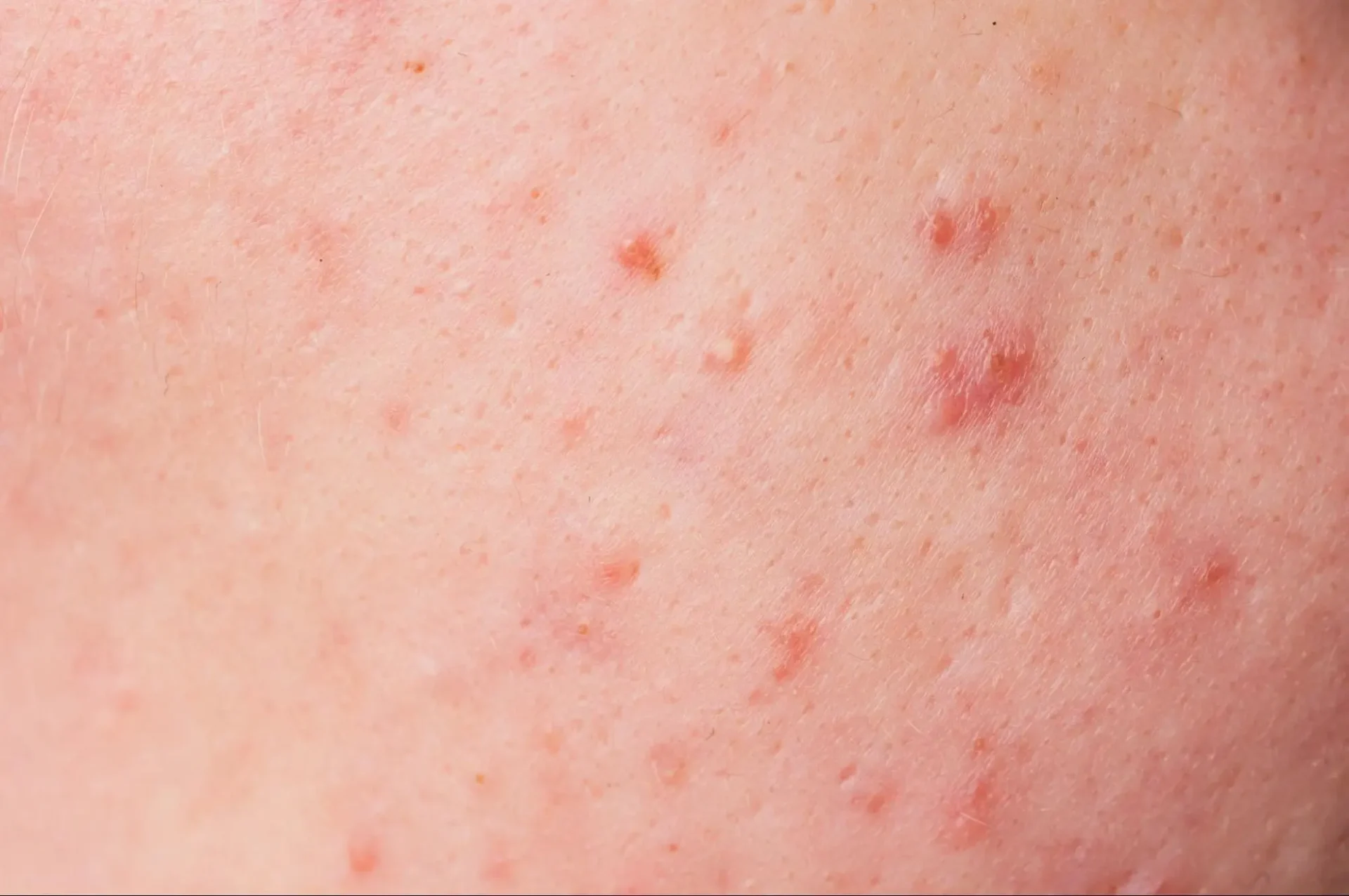 สิวไม่มีหัว นูน ๆ เกิดจากสาเหตุอะไร